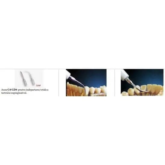Ansă Detartraj Interproximal Woodpecker G4 - Eficiență în Profilaxie — imaginea 2