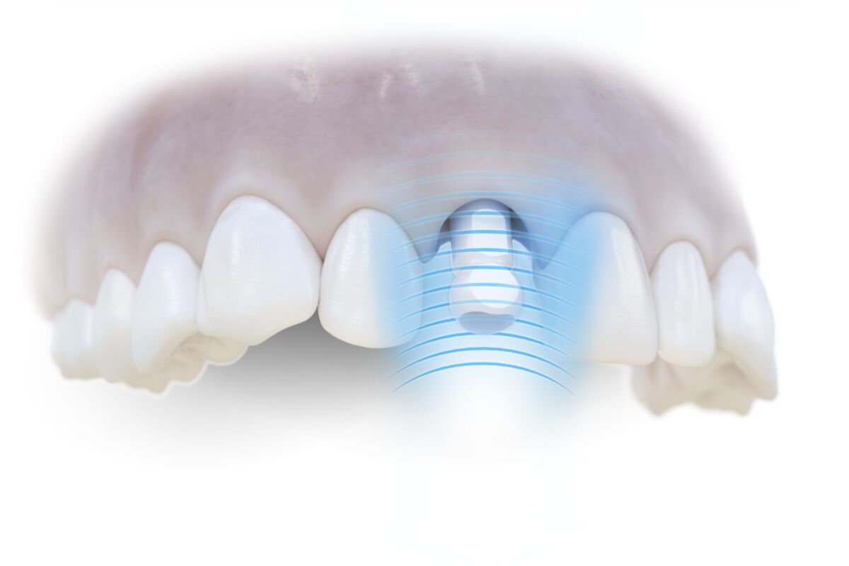 ATLANTIS intraoral FLO IO-H-02 35229 pentru Straumann Dentsply Sirona