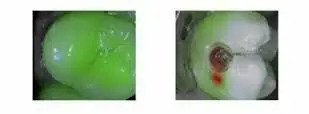 Detector de carie dentară C-Hunter COXO – depistare rapidă și precisă — imaginea 4